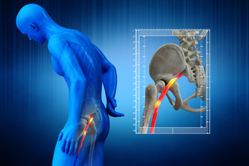 Pinched human sciatic nerve, anatomical vision. 3d illustration.