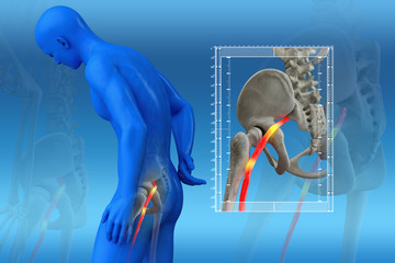 Pinched human sciatic nerve, anatomical vision. 3d illustration.