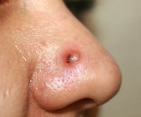 Fototapeta premium Inflamed pimple on nose. Cyst Acne. Acne on the skin
