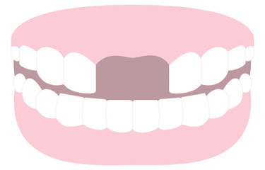 前歯が日本抜けた歯のイラスト