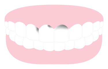 前歯に進行した虫歯のある歯のイラスト