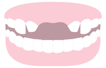 前歯にブリッジをかけるために削った歯のイラスト