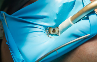 Treatment of dental canals in the upper molar permanent molar using an apex locator file, a tooth...