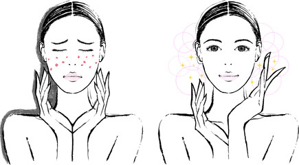 女性　ニキビ　ビフォーアフター