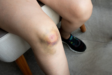 Woman with Bruise on knee from accident