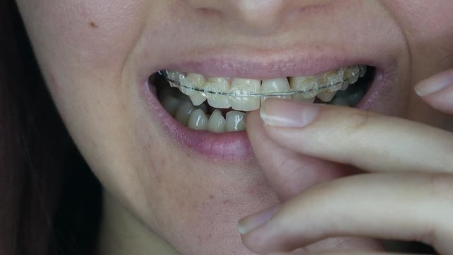 A woman's smile. Smile without upper left unit teeth. Tooth model with metal wire dental brace. Single Missing Tooth - Removable partial denture. One false plastic tooth. 