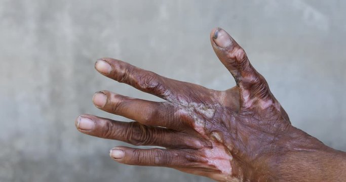 The hand of an accidentally disabled person,Hand scar, wrinkled skin, dirty hands,Wounds caused by a serious accident on a woman's body