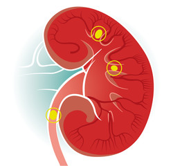 Human body view of kidneys. The kidneys are two bean-shaped organs found in vertebrates. Kidney stones