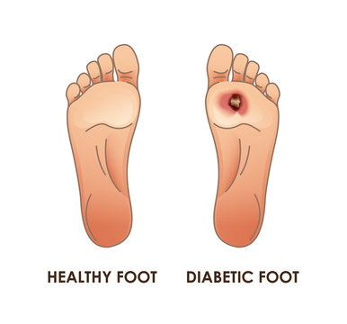 Diabetic and healthy foot. Vector illustration