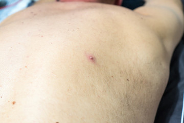 a pimple on the skin of a light-skinned man.