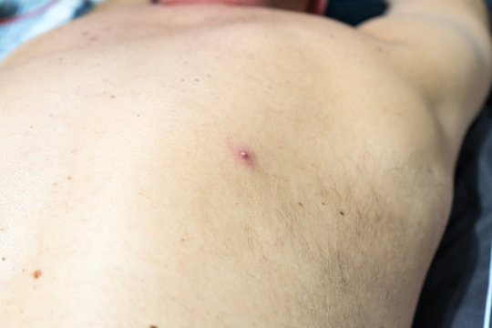 a pimple on the skin of a light-skinned man.