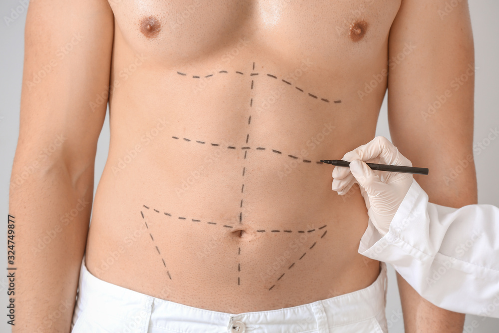 Wall mural plastic surgeon applying marking on male body, closeup