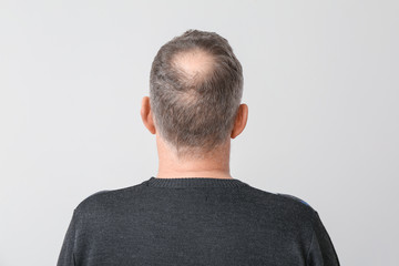 Senior man with hair loss problem on light background