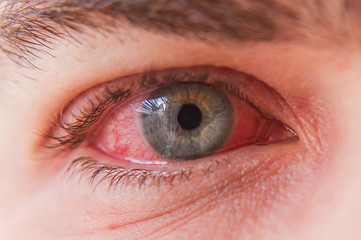 Macro closeup of  conjunctivitis infeced red eye - obrazy, fototapety, plakaty