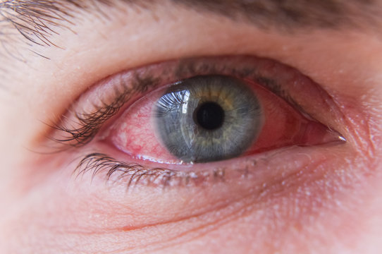 Macro closeup of  conjunctivitis infeced red eye