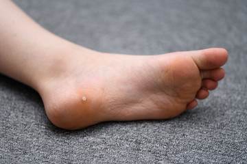 Foot wart, verrucas plantar on the foot of a child from Sweden. A  decease caused by the Human pallomavirus and often spread at communal showers or by sharing socks with others. - obrazy, fototapety, plakaty