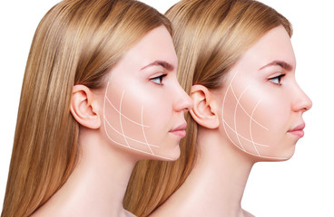 Young woman with lifting lines before and after chin correction.