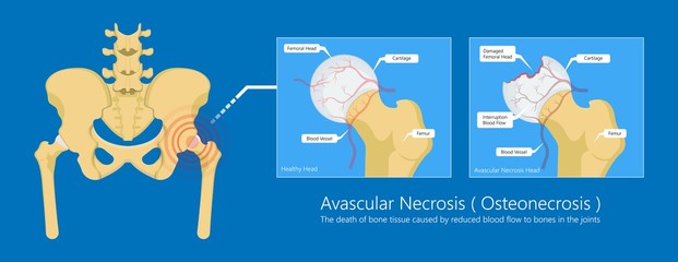 Avascular necrosis bone tissue disease - obrazy, fototapety, plakaty