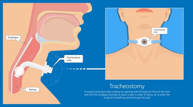 Tracheostomy tube medical procedure neck windpipe emergency breathing