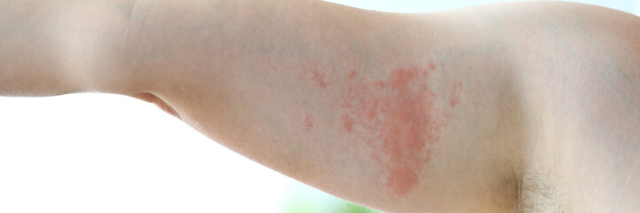 Fototapeta premium Focus on dermatological skin infection spreading throughout whole body of poor suffering patient. Professional dermatology clinic advertisement concept