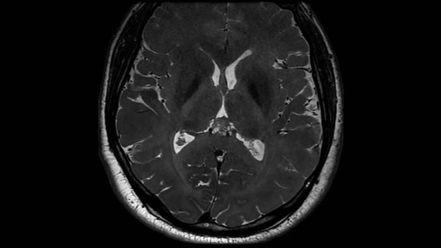 A Case Of Magnetic Resonance Imaging Of An Enlarged Pituitary Gland In The Brain. -close up shot
