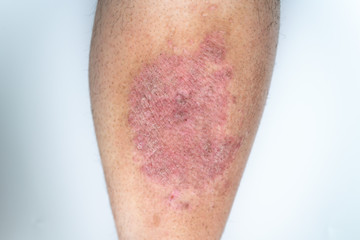 Fototapeta premium 乾癬・皮膚炎・湿疹