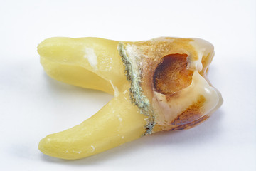 affected by caries, destroyed with a large cavity, removed human tooth with large roots, chewing molar tooth, wisdom tooth, tooth extraction operation, dental surgery, dental care