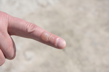 Big bublle Blister on man finger on background, Isolated