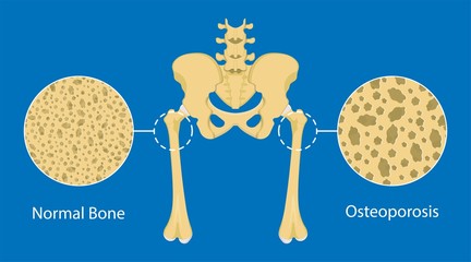 Bone mineral density BMD osteoporosis dual energy X-ray absorptionmetry adult disease equipment medical clinic central DXA pain radiography hospital fragility risk examine