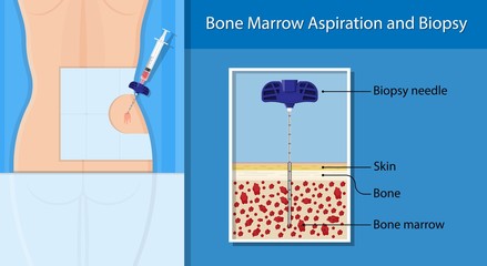 Bone biopsy medical marrow harvest stem cell transplants aspiration specimen cancer procedure sample test treatment diagnosis anemia blood cell lab - obrazy, fototapety, plakaty