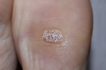 Fototapeta premium HPV Close-up shot of a plantar wart on the bottom of the big toe caused by the human papillomavirus.