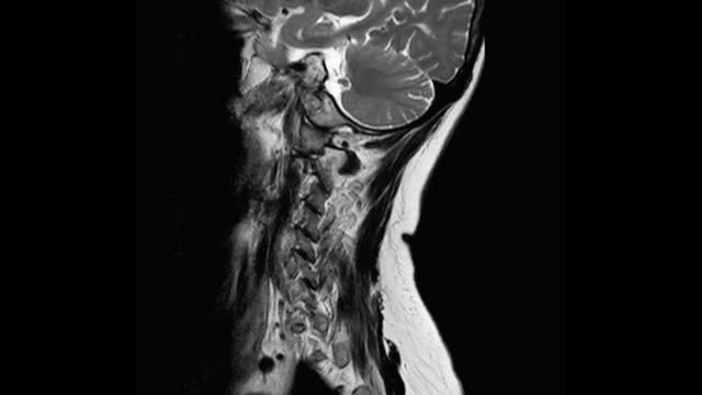 MRI of cervical spine sagittal T2W view  for diagnostic Spinal Cord Compression at C3,C4.