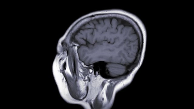 MRI of the brain sagittal view T1 technique showing anatomical of the brain .