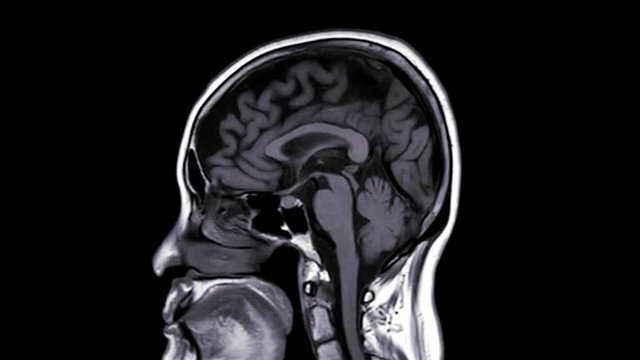 MRI of the brain sagittal view T1 technique showing anatomical of the brain .