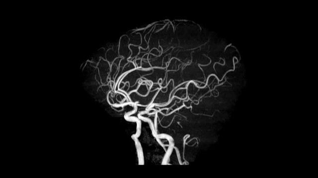 MRA Brain or Magnetic resonance angiography (MRA) of Vessel in the brain turn around on the screen. MRA Brain MIP view for evaluate cerebral artery.