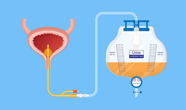 Urine bag medical treatment drainage bladder rubber flexible body infection bacteria output measure tract toilet leg relieve cancer device calculi vesical problem anatomy sterile surgical urethra