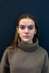 Girl with acne on her face. The girl is worried about acne on her face. A girl suffers from acne on...