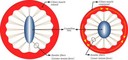 The accommodation of the crystalline lens is due to the contraction of the ciliary muscles. This results in the variation of the tension in the zonular fibers and the variation thickness of the lens.