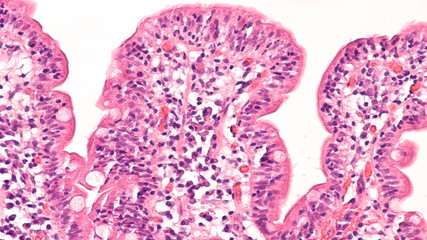 Histology of duodenal biopsy from patient with bloating and diarrhea from celiac diseae (sprue,...