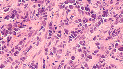 Lung Cancer Awareness; Photomicrograph of neck lymph node showing  metastatic small cell (oat cell) carcinoma in  patient with a history of smoking, demonstrating characteristic nuclear molding.   