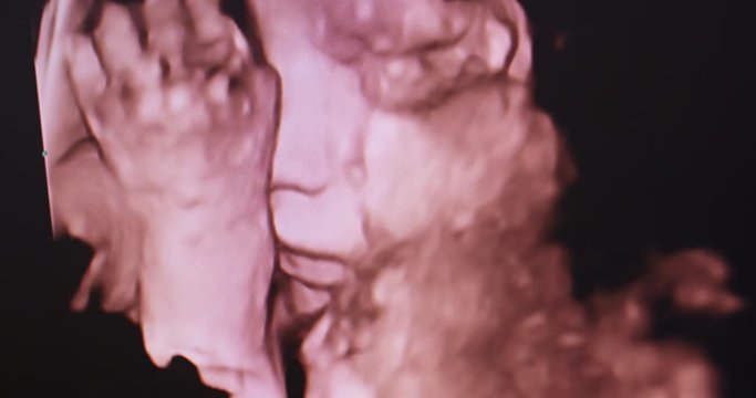3D sonography or medical ultrasound examination of a 30-week-old fetus.
