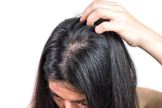 women head with dandruff Caused by the problem of dirty. Or caused by skin disease or Seborrheic Dermatitis. It has white scaly and it will cause itch. Product Concepts Scalp Care and Hair Care.