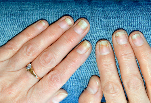 Fungal nail infection, onycholysis after shellac or gel-varnish.