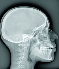 MRI magnetic resonance image of the human brain