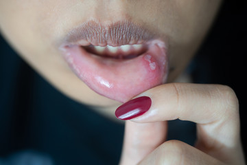 Woman having a swollen lower lip, caused by mouth ulcers - obrazy, fototapety, plakaty