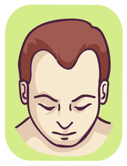 Man Pattern Baldness Hairline Loss Illustration