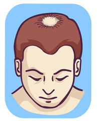 Man Pattern Baldness Hair Loss Vertex Illustration