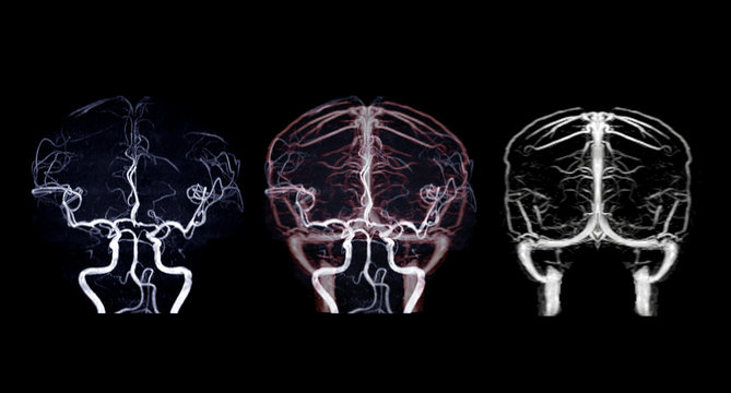  MRA Brain and MRV Brain .