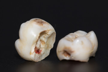 tooth decayed caries on a black background