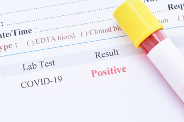 Blood sample tube positive with COVID-19 or novel coronavirus 2019 found in Wuhan, China